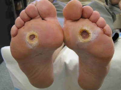 Diabetic-Foot.jpg