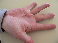 Hand Disease.jpg