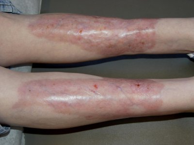 Necrobiosis lipoidica diabeticorum.jpg