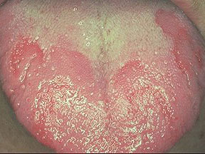 tongue disease.jpg