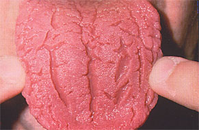 Tongue Disease.jpg