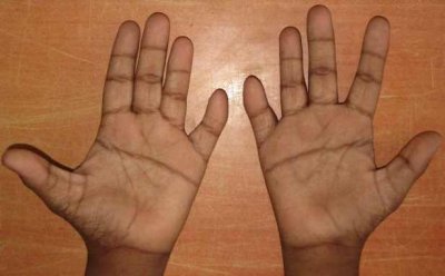 Pediatric Hand.jpg