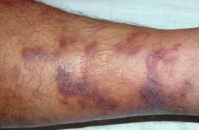 kaposis-sarcoma.jpg