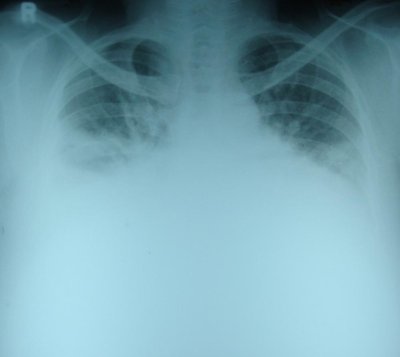 chest x ray.jpg