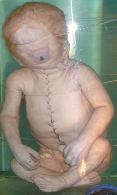 360px-Child_with_Cyclopia.jpg