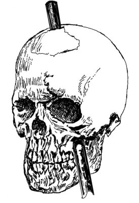 Schedel Phineas Gage.jpg