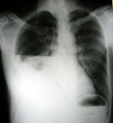 chest xray.jpg