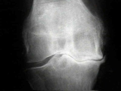 Knee Xray.jpg