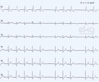 second-degree-heart-block-mobitz-2-ekg-ecg.jpg