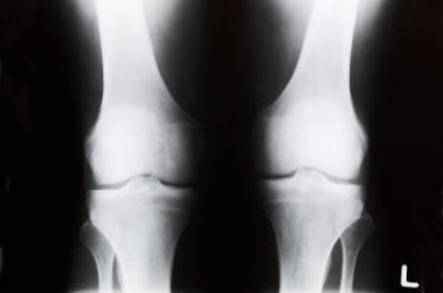 Knee Xray.jpg