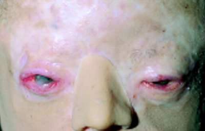 Günther's disease.jpg