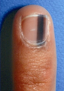 Nail Disease.jpg