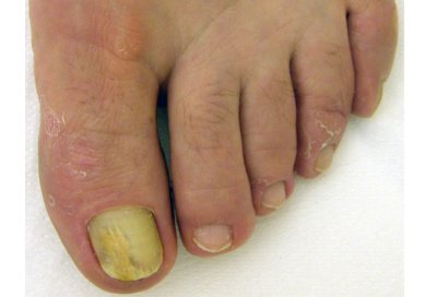 onchomycosis.jpg