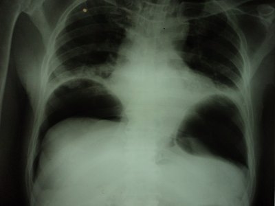 Pneumoperitonium.jpg