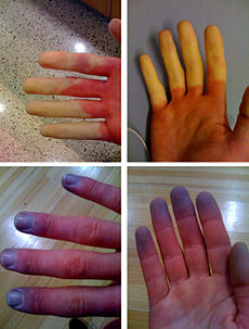 230px-Raynaud's_Syndrome.jpg