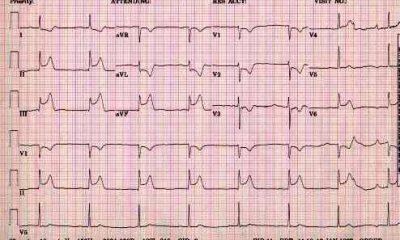 ECG.jpg