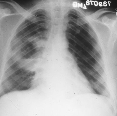 Lung Xray.jpg