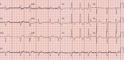 ekg.jpg