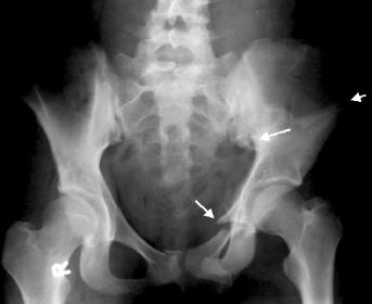 Pelvic Xray.jpg