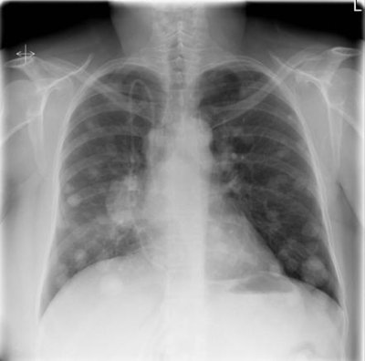 Lung Xray.jpg