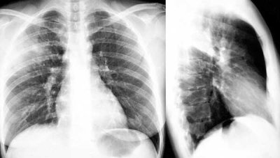 Chest Xray.JPG