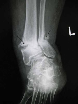 Ankle Xray.JPG