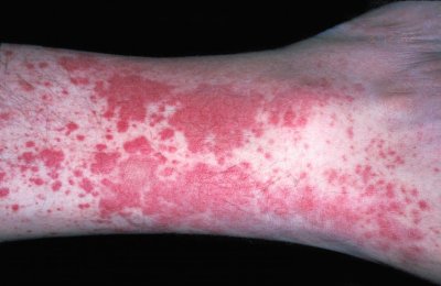 Vasculitis_Hypersensitivity-1.jpg