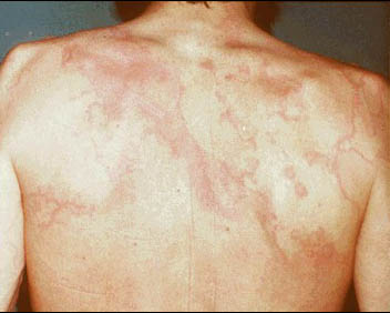 Erythema_marginatum_1.jpg