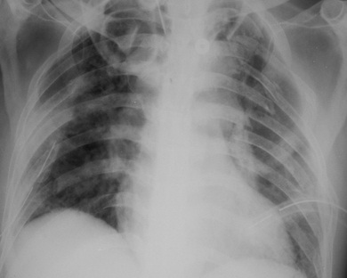 Chest Xray .jpg