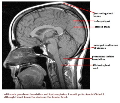 Arnold chiari 2.jpg