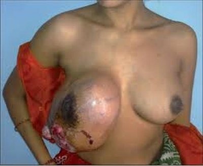 Breast mass.jpg