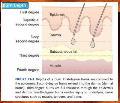 Burn depth.jpg