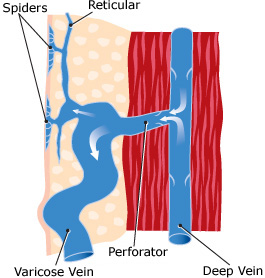 spiderveins-1.jpg