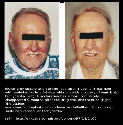 amiodarone skin toxicity.JPG