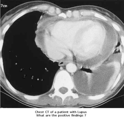 Chest CT - Lupus.JPG