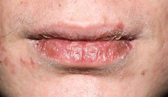 5 Tips for Battling Cracked Lips.jpg