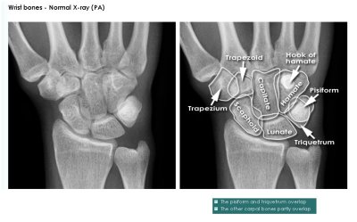 hand and wrist xray PA view.JPG