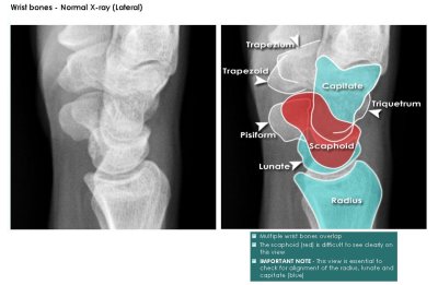 hand and wrist xray lateral view.JPG