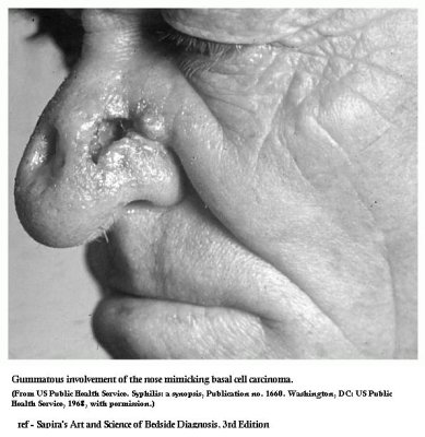 Syphylis gumma nose.JPG