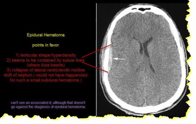 Copy of Copy of Epidural Hematoma.jpg