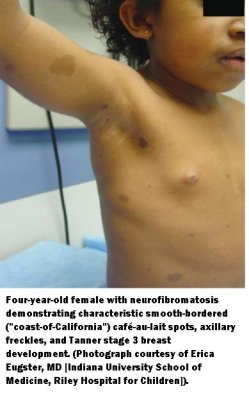 axillary freckling.JPG