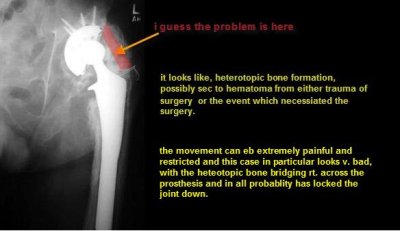 heterotopi bone.JPG