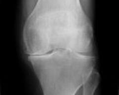 Knee Xray.jpg