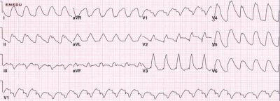 ECG.jpg