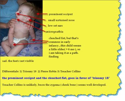 trisomy 18.jpg