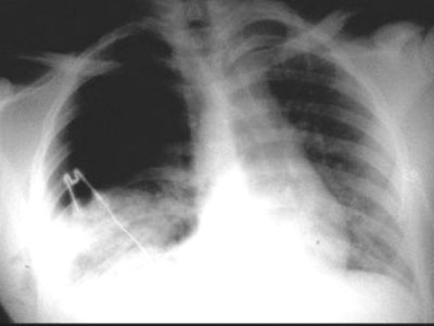 Chest Xray.jpg