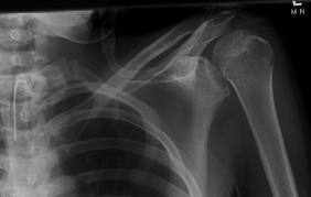 Shoulder Xray.jpg