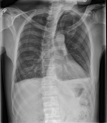 Chest Xray.jpg