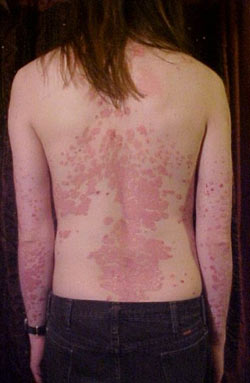 psoriasis.jpg