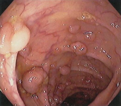 colostomia no disminuye el riesgo de cancer debido a adenomas  de otros sitios especialmente amp.jpg